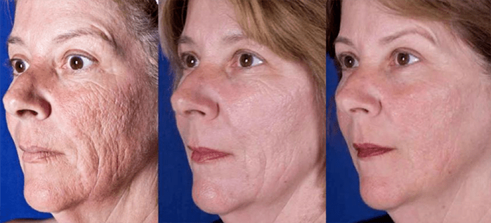 Résultats après la procédure de rajeunissement du visage au laser