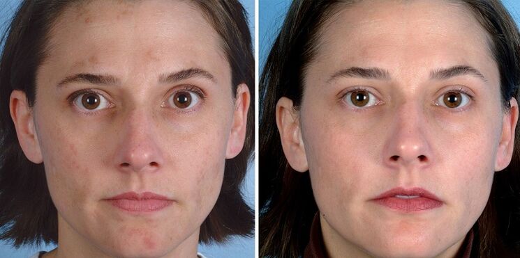 Avant et après l'utilisation de l'appareil pour le rajeunissement de la peau