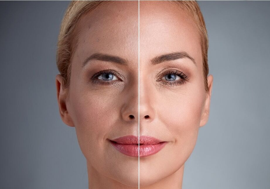 Avant et après le rajeunissement du visage au laser
