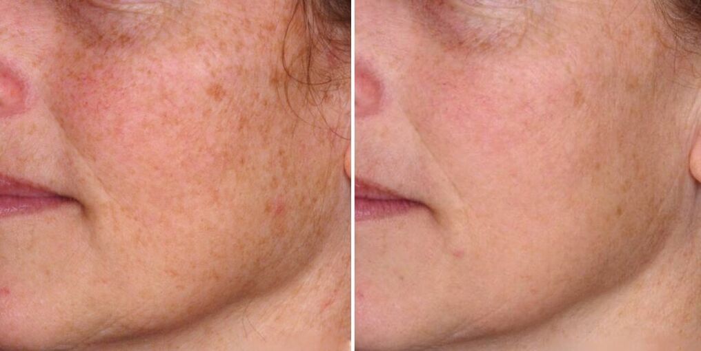 Avant et après le rajeunissement de la peau du visage