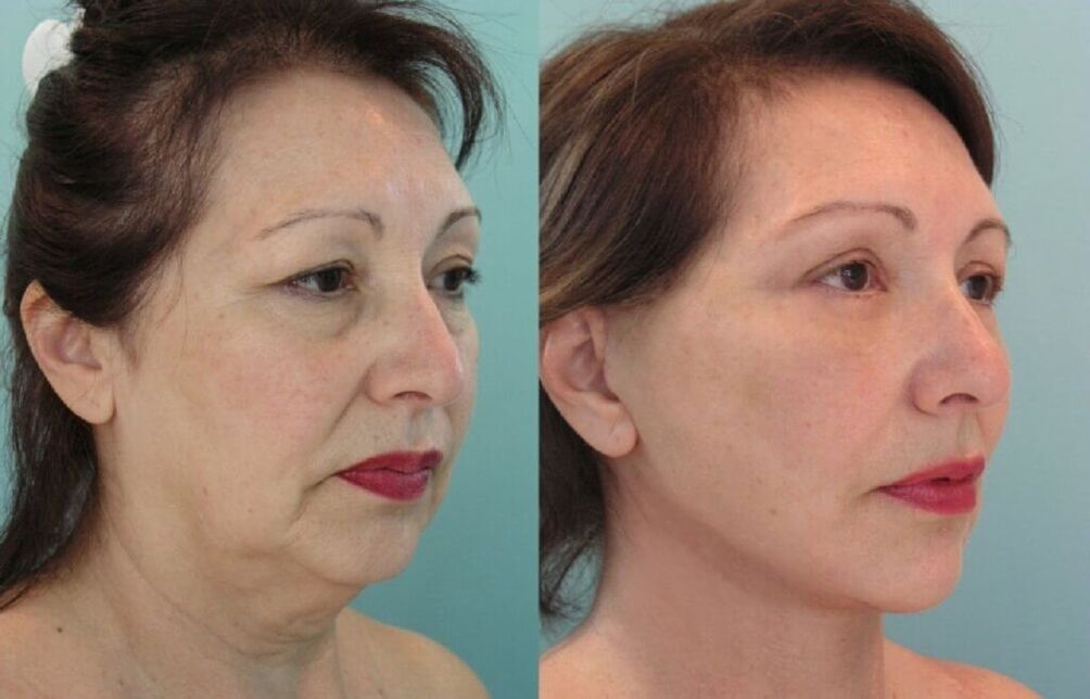 Photos avant et après le rajeunissement de la peau